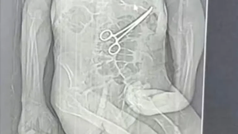 Investigação em MG: Idoso Morre Após Cirurgia com Instrumento Esquecido