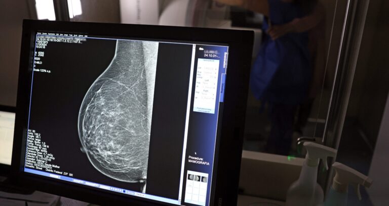 Inteligência Artificial Revela Risco de Doenças Cardíacas Através de Mamografias