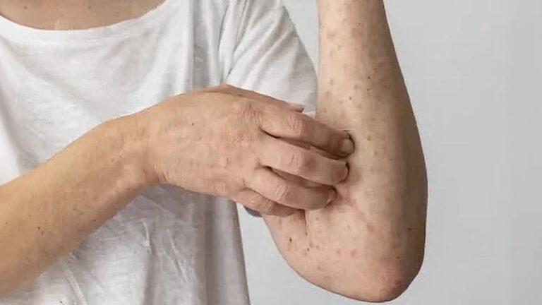 Ministério da Saúde Confirma Caso de Sarampo no Rio de Janeiro e Adota Medidas de Controle