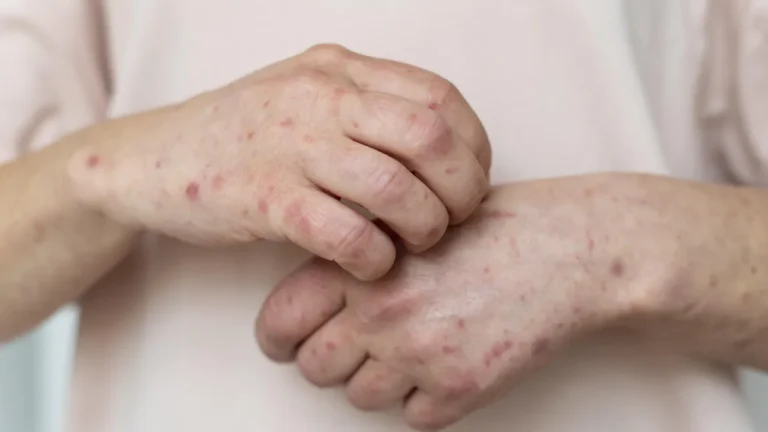 Rio de Janeiro Confirma Caso de Sarampo: O Que Você Precisa Saber